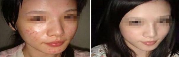 隆鼻術后一個月修復措施有哪些？