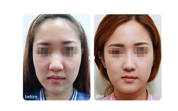 7d聚拉提果真的那么神奇嗎？挽救肌膚年齡，還讓你重獲青春之美！