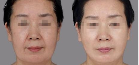 磨骨風險大？解讀術后出血、感染、神經麻木等風險與費用