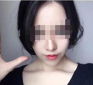穆雄錚顴骨整形手術(shù)解析，修復(fù)顴弓美麗重生！顴骨整形術(shù)后恢復(fù)時(shí)間淺析