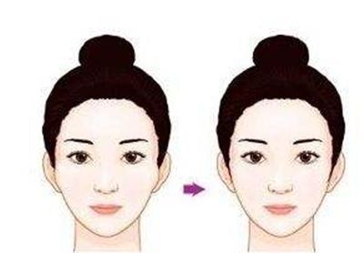 蘇州隆鼻手術(shù)費(fèi)用及效果如何？