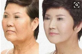 15歲女孩整容成果驚人！爸媽都認(rèn)不出來了