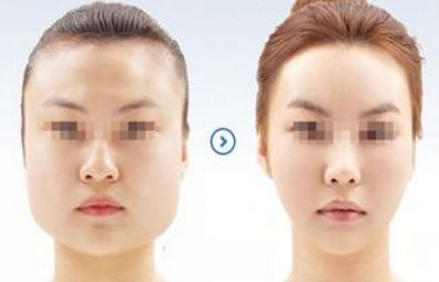 施爾美上瞼松弛矯正：修正眉形，讓你擁有迷人雙眼！