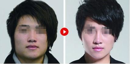 隆鼻修復(fù)，如何科學(xué)達到理想效果？