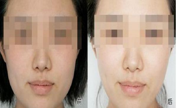 修復(fù)雙眼皮失敗的方法與效果，全面解析助你成功擁有完美雙眼皮