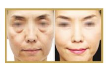 酒窩的定義及相關(guān)風(fēng)險，你知道嗎？