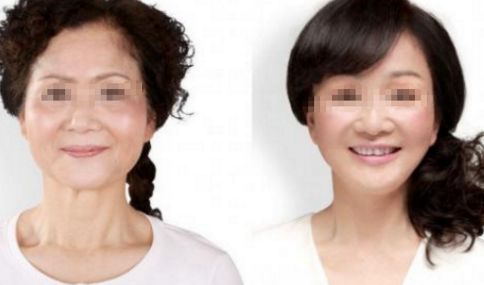 腹部抽脂術的疼痛感受，了解一下!