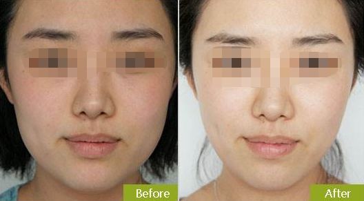 擁有光滑年輕肌膚，無(wú)需手術(shù)的神奇彩光嫩膚方法