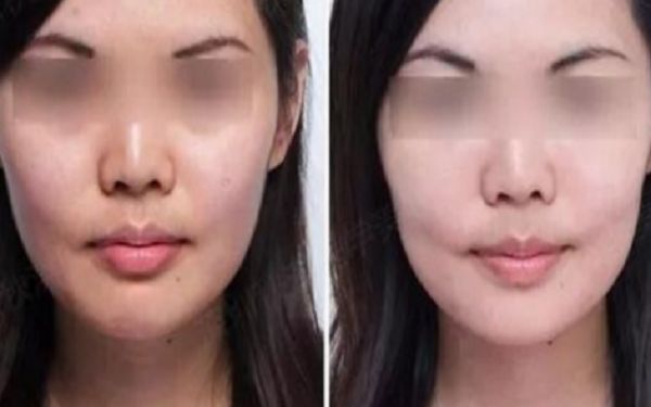35歲采用超聲療程好還是熱瑪吉更好？匿名評(píng)測(cè)揭秘！