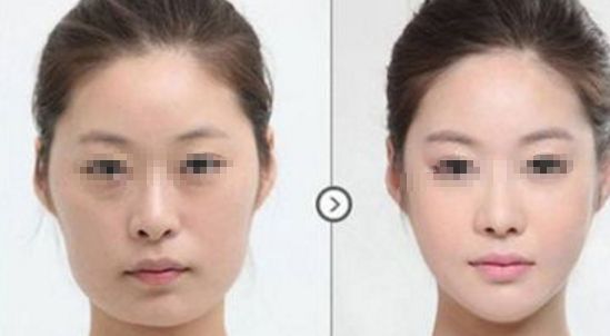 皮膚松弛，如何選擇適合的醫(yī)美項目？熱門方式如熱瑪吉、拉皮等對比解析！