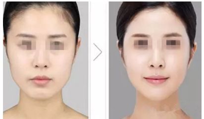 陰道緊縮術(shù)是否痛苦，了解手術(shù)前后的疼痛情況