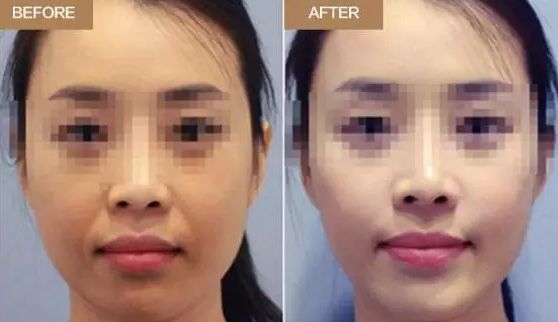 武漢注射法隆鼻價(jià)格、適宜人群都想知道