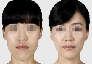肋骨隆鼻后的面部消腫需要多長(zhǎng)時(shí)間？消腫小竅門曝光！