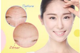 開內(nèi)眼角手術(shù)的疼痛程度如何？解析內(nèi)眼角手術(shù)的全貌