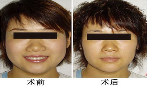 咬肌切除手術(shù)后對面部功能是否會受影響？