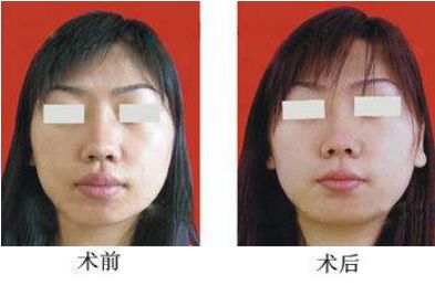 隆鼻手術(shù)費用及失敗原因，臨床體征全解析
