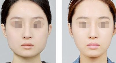 填充鼻唇溝使用玻尿酸安全又有效嗎？