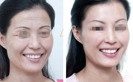 面部吸脂瘦臉效果如何？達(dá)到自然效果的關(guān)鍵是什么