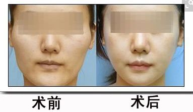 鼻骨矯正對(duì)外貌有何影響？矯正費(fèi)用合理嗎？