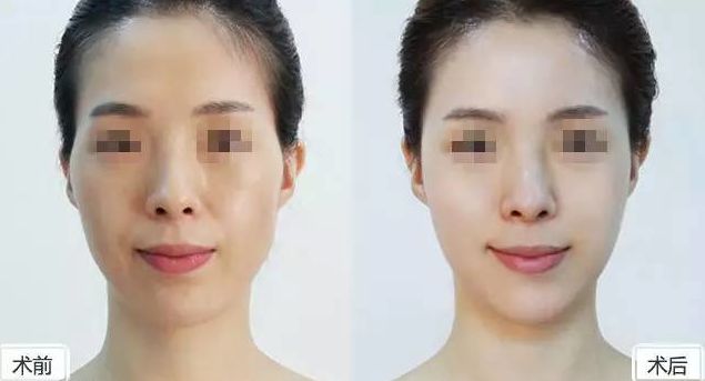 假體隆胸保持持久效果有多久？假體隆胸2個(gè)月后是否固定？