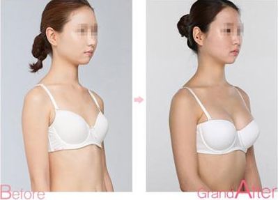 成都耳軟骨復(fù)合隆鼻手術(shù)：專家解析耳軟骨隆鼻效果及價格、術(shù)后護理