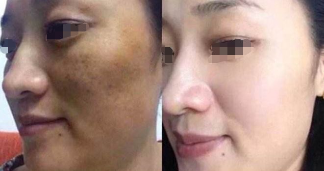 淚溝填充：熊貓針VS膠原蛋白，手術(shù)過程與注意事項解析