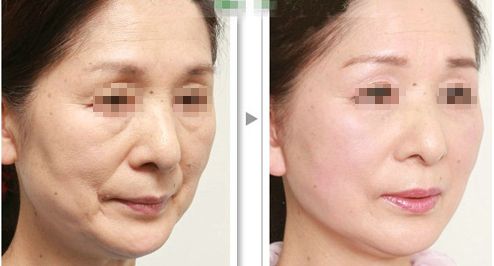 解脂能祛眼袋嗎？多少錢？功效與注意事項(xiàng)詳解