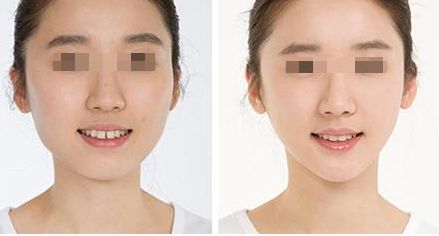 鼻整形手術價格分析：效果原理講解，術后注意事項，不良反應剖析