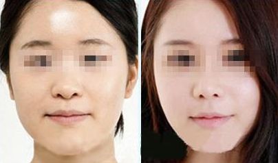 激光祛胡脂肪堆積有安全風(fēng)險(xiǎn)？您了解情況嗎？
