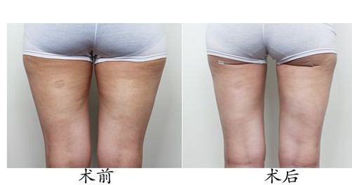 體驗光子嫩膚，解密北京光子嫩膚價格