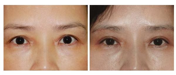 女生變成網(wǎng)紅臉需要多少投入？解析投資成本及效益