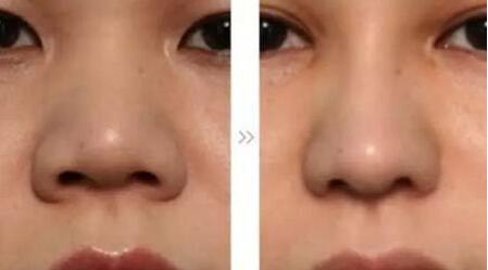 哪位醫(yī)生在全國范圍內的脂肪填充領域技術比較好？