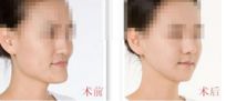 廣東省人民醫(yī)院美容科專家團隊與隆鼻手術揭秘
