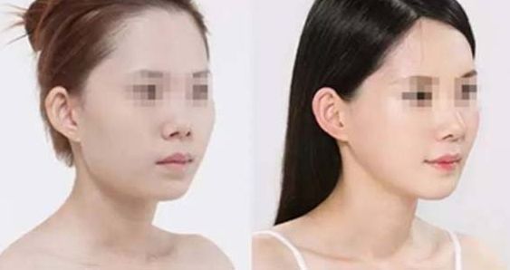 石家莊哪家整形醫(yī)院在隆鼻方面有口碑？