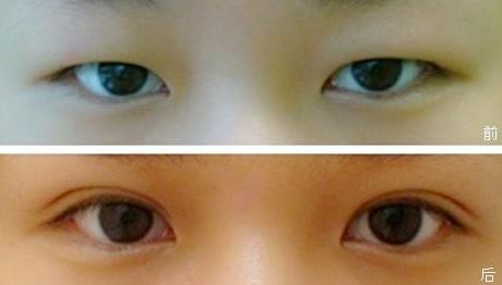 上海九院雙眼皮手術效果怎么樣？錢云良醫(yī)師的全新案例分享