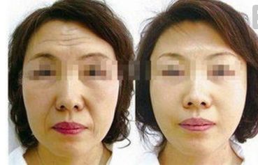四川人民醫(yī)院王佳醫(yī)生提供下頜角整形案例，讓你輕松擁有小V臉