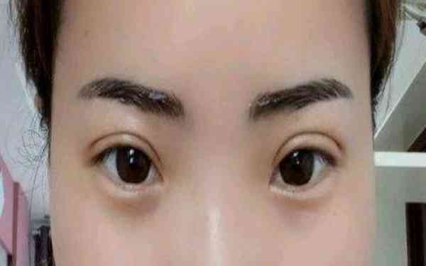 丁硯江填充脂肪的效果如何？為什么該方法備受推崇？