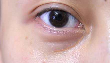 【重慶】銅雀臺雙眼皮醫(yī)生技術(shù)對比，伍森林、王杰醫(yī)、梁海彬誰更厲害？