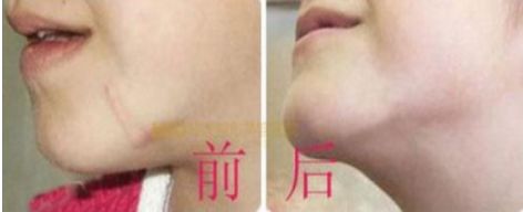 長沙最佳吸脂手術醫(yī)院排名，雅美、華韓華美、鵬愛等值得借鑒的評價