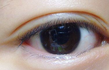 健麗整形醫(yī)院的去眼袋效果如何？2023患者分享案例！