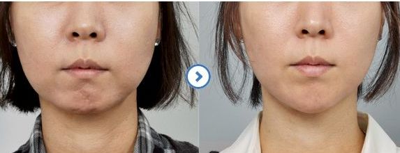 合肥近視矯正專家排行榜比較瑞亞與華美最佳眼部整形醫(yī)院 合肥近視矯正專家排行榜比較瑞亞與華美最佳眼部整形醫(yī)院