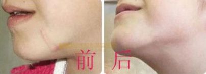 上海哪家醫(yī)院有專業(yè)的唇裂手術醫(yī)生？治療兔唇患者的必備信息！