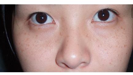 張恒術(shù)雙眼皮手術(shù)80天后效果揭曉，驚喜呈現(xiàn)！
