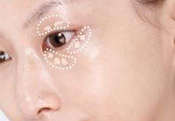 杭州葉秀娣做雙眼皮具體效果如何？專家實(shí)踐案例發(fā)布