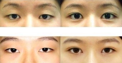 成都雙眼皮修復(fù)醫(yī)生最新名單出爐！頂尖專家蔡玲、王強等領(lǐng)銜榜單