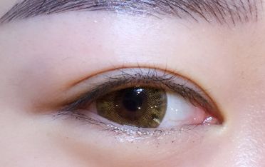 鄒翀，這一雙眼皮技術(shù)，近期有所革新