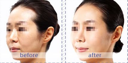 南京脂肪填充整形醫(yī)院推薦，蘇王、維多利亞和康美三家不容錯(cuò)過(guò)的選擇