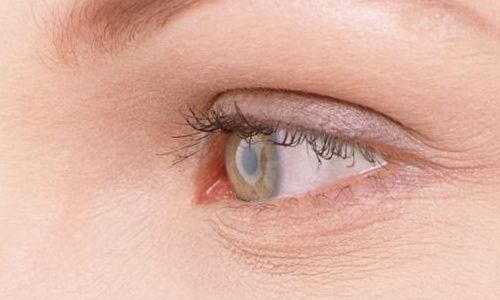 航空院眼袋手術效果如何？最新案例分享
