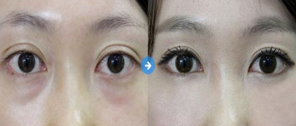 盤點(diǎn)北京7大值得信賴的開眼角整形醫(yī)生
