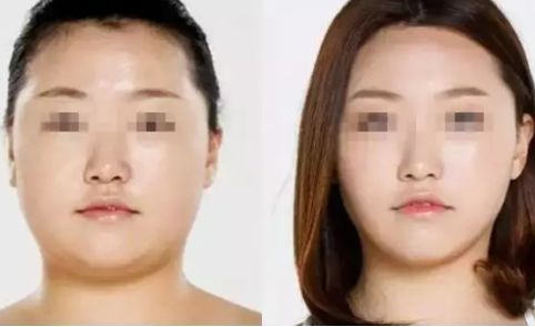 寧波2023年抽脂醫(yī)生排名揭曉！這幾位口碑爆棚的專家堪稱翹楚！